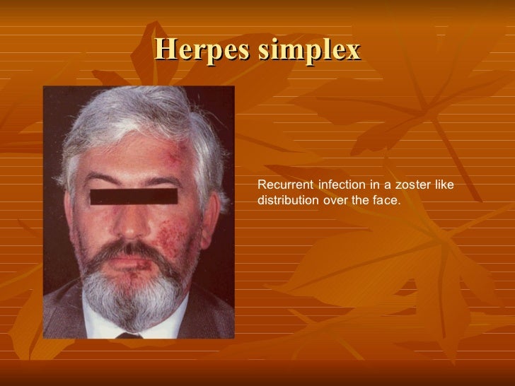 facial viral infections Boys stuff porn